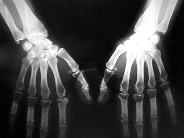 røntgen av hender